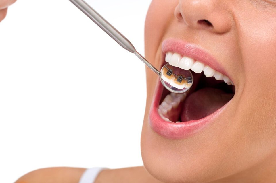 lingual braces