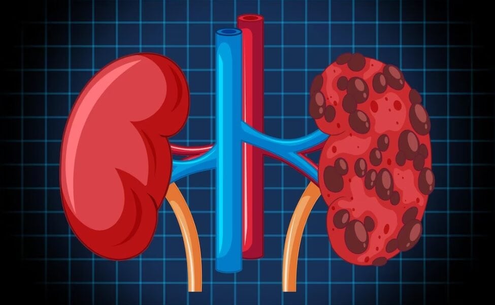 Kapalı Böbrek Ameliyatı