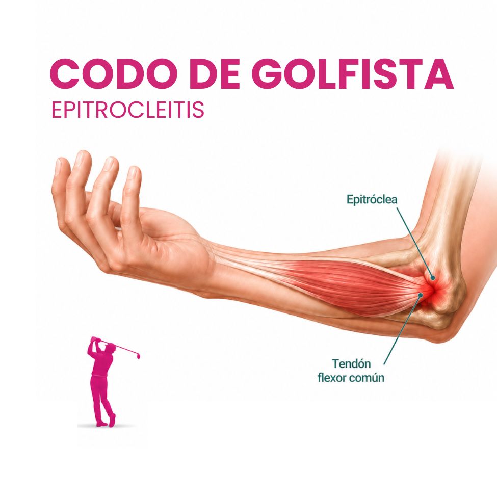 codo de golfista epitrocleitis cara interna del codo