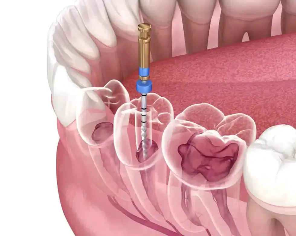 3D illustration of the endodontic procedure used in root canal treatments in Riverview, MI
