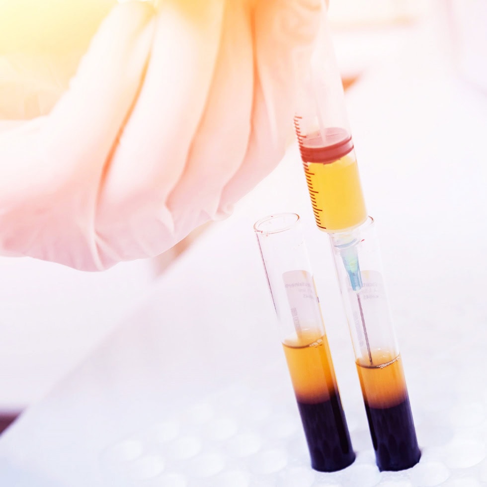 Platelet-rich plasma (PRP) being carefully drawn from a centrifuge tube after blood separation for regenerative injection therapy at BionwoRx in Carmel, Indiana.