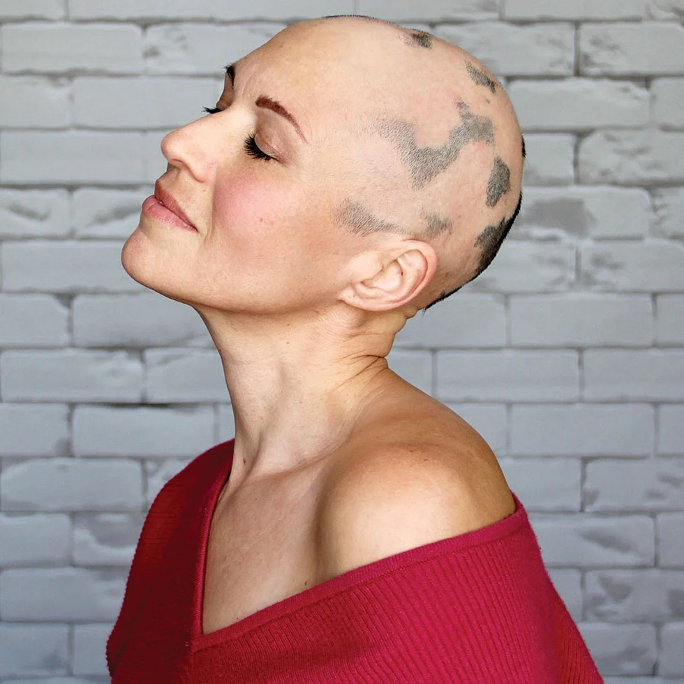 Alopecia