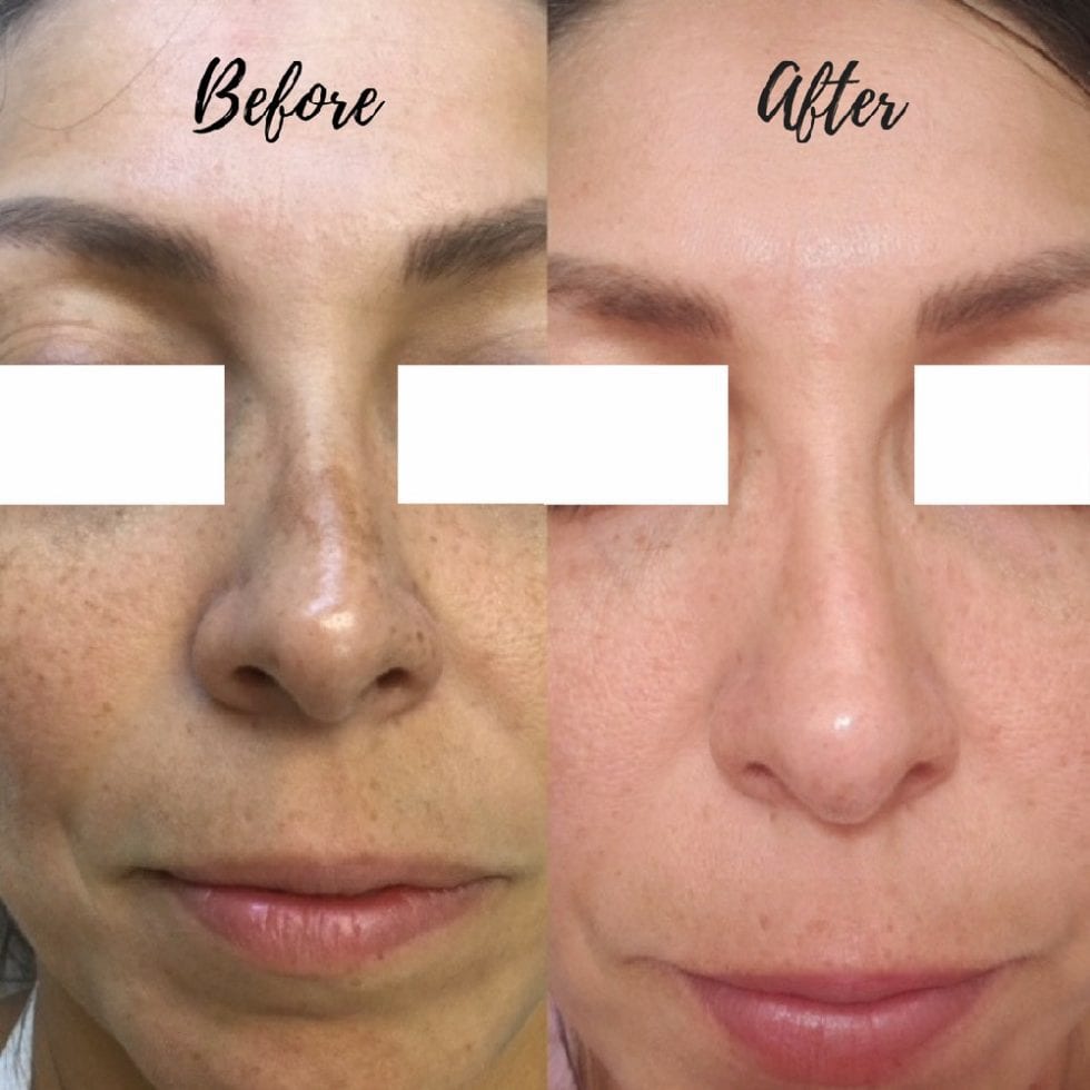 IPL Photofacial