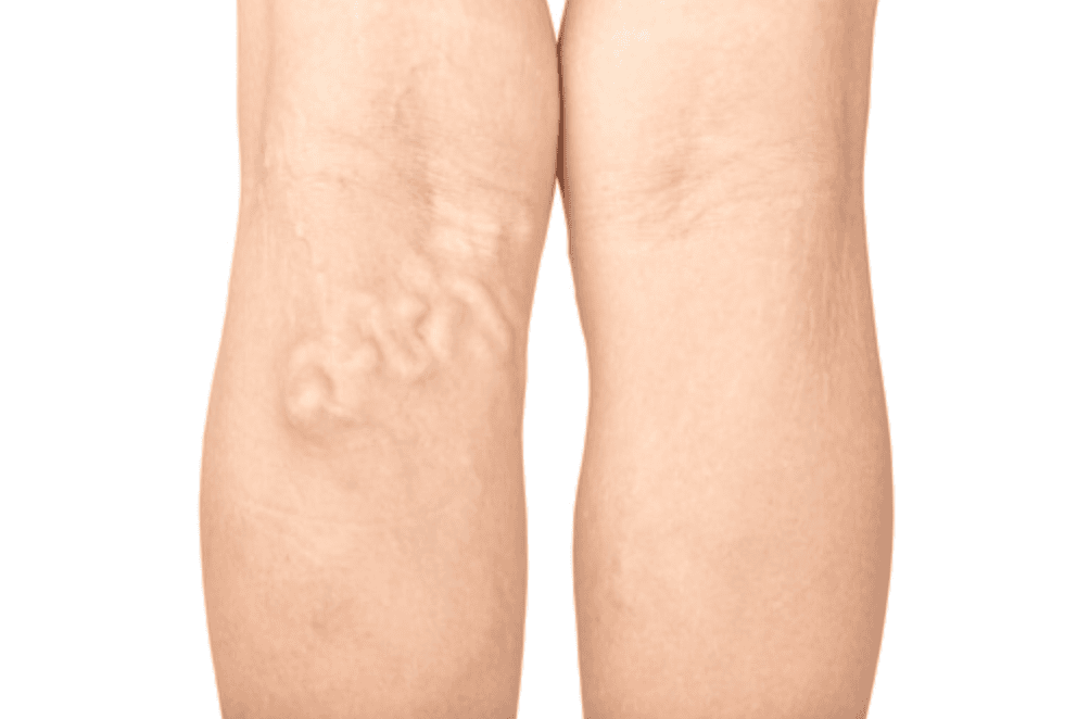 Masalah kesehatan Deep Vein Thrombosis