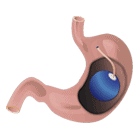 Balón Gástrico por endoscopia.