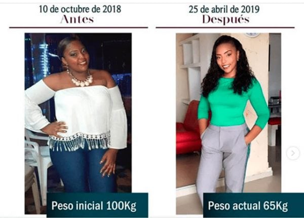 Cirugía de Manga Gástrica (Sleeve) a paciente con obesidad
