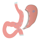 Sasi Bypass. Cirugía Diabetes Tipo 2 y Obesidad Mórbida.
