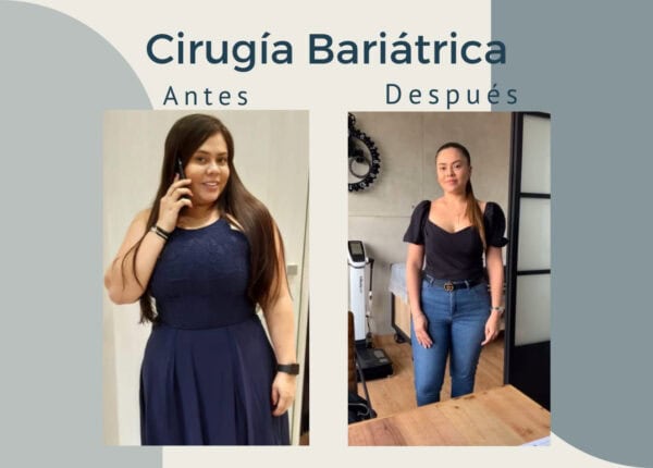 Cirugía Bariátrica. Un gran cambio.