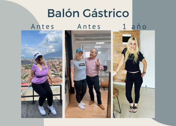 Balón Gástrico Bariatrix. Excelente cambio.