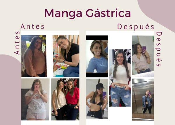 Manga Gástrica. Excelente resultado