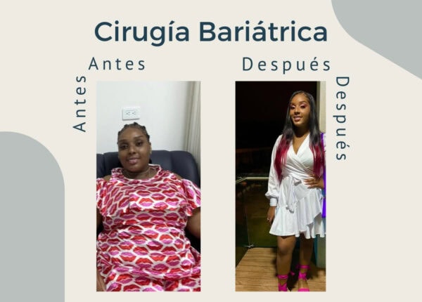 Un gran resultado de Cirugía Bariátrica.