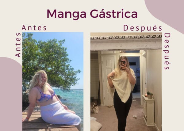 Un excelente cambio gracias a la Manga Gástrica.