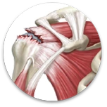 Rotura del manguito rotador