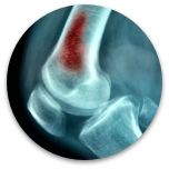 Infecciones osteoarticulares