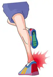 アキレス腱炎