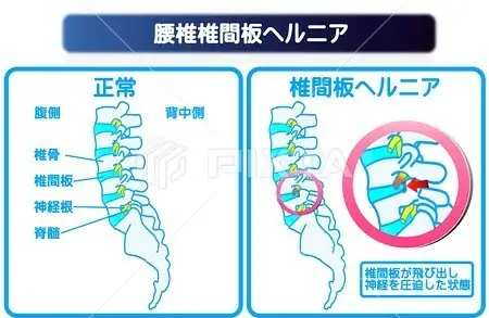 腰椎椎間板ヘルニア