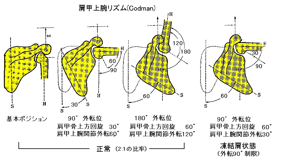 一般的には保存療法（リハビリ）で行われます