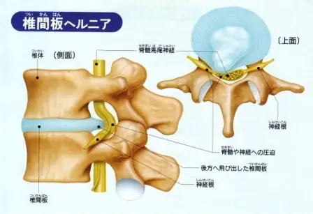 脊柱管狭窄症
