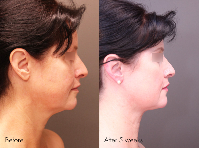 Pre Treatment, 5 weeks post Renuvion of the Neck and Profound with of the Face