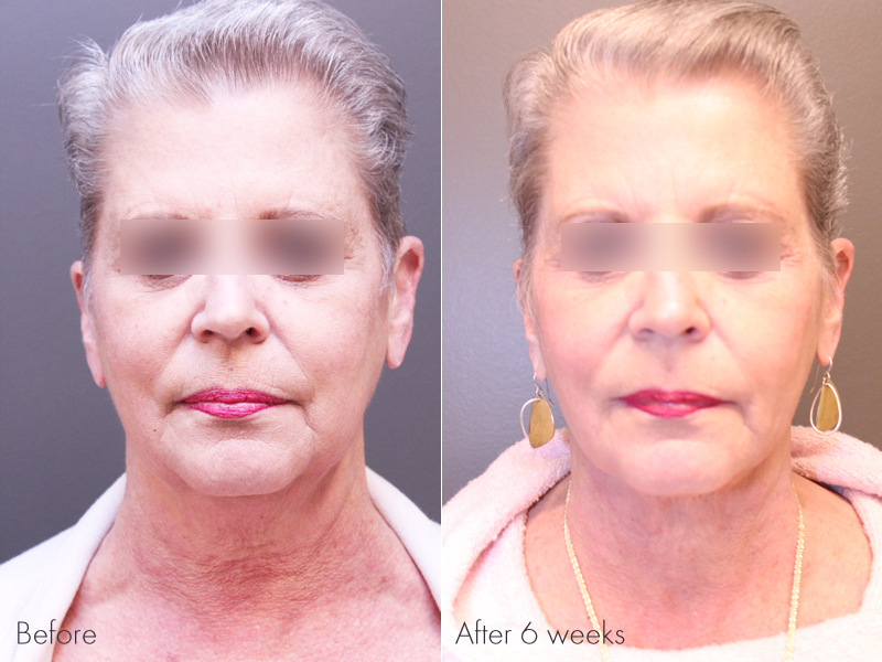 Pre Treatment, 6 weeks post Renuvion of the Neck with Liposuction for the jowls and Profound with PRP of the Face