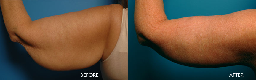 55 year old - Brachioplasty (Arm Lift)
