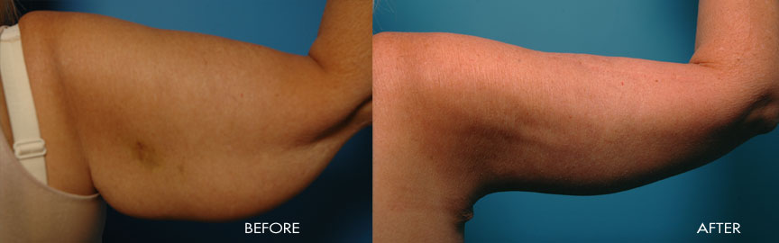 55 year old - Brachioplasty (Arm Lift)