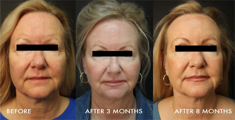 Pre Profound treatment, 3 months post, and 8 months post single Profound Treatment