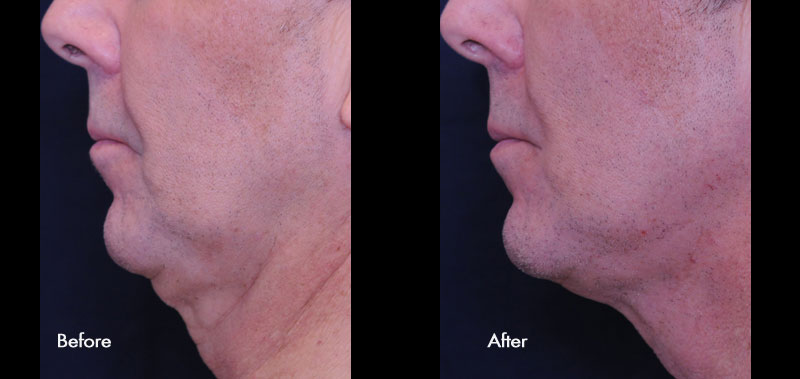 3 months post single Profound Treatment