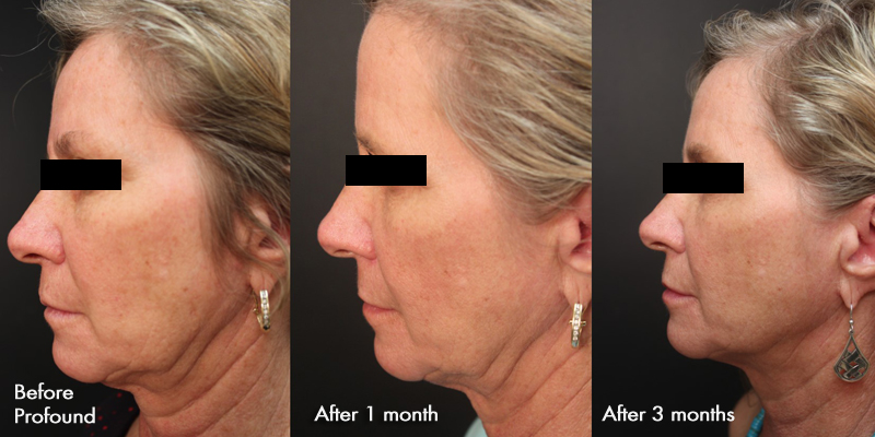 Pre Profound Treatment and after 1 month and 3 months after Profound