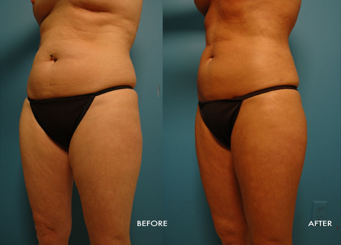 Womans torso before and after Vaser Shape procedure
