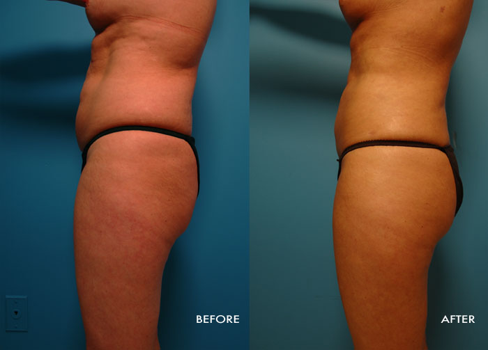 Womans torso before and after Vaser Shape procedure