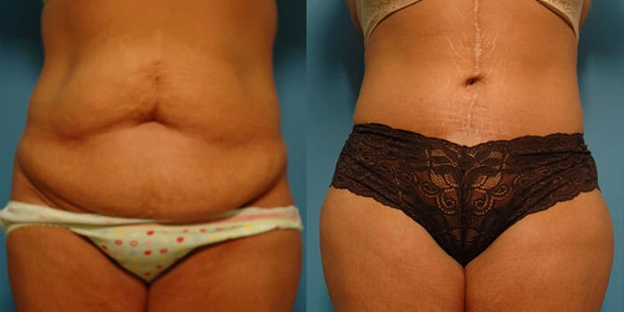 Abdominoplasty Tummy Tuck