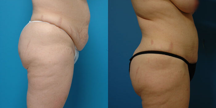 Abdominoplasty Tummy Tuck