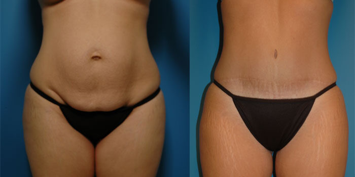 Abdominoplasty Tummy Tuck
