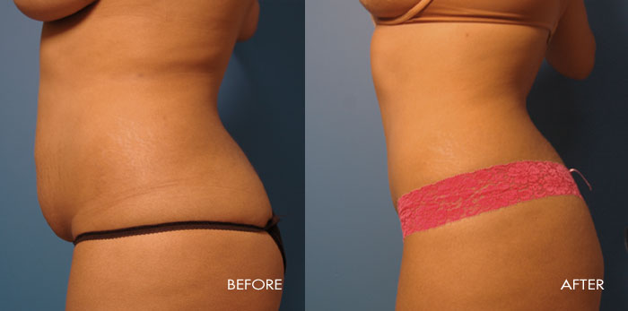Abdominoplasty Tummy Tuck