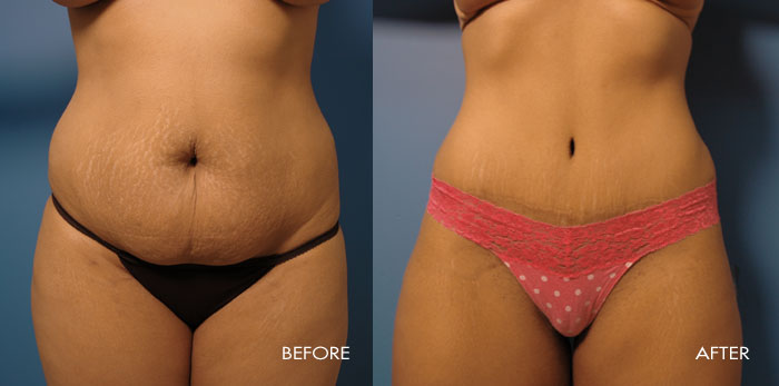 Abdominoplasty Tummy Tuck