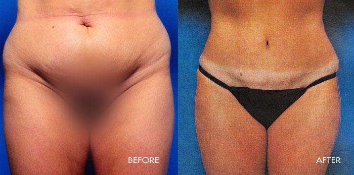 Abdominoplasty Tummy Tuck