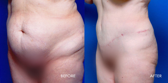 Abdominoplasty Tummy Tuck
