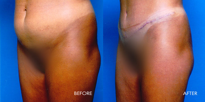 Abdominoplasty Tummy Tuck