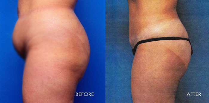 Abdominoplasty Tummy Tuck