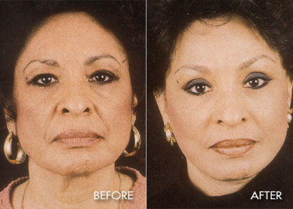 Blepharoplasty
