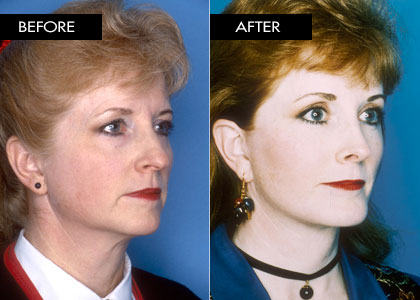 52 year old - Facelift, Blepharoplasty, Brow Lift, Rhinoplasty, Chin Implant, Deep Laser Resurfacing