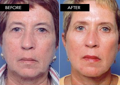 Blepharoplasty
