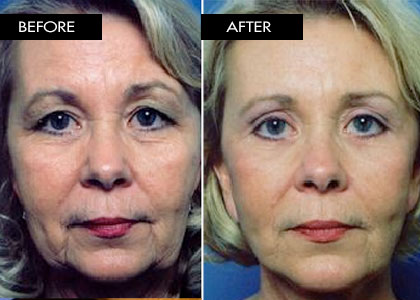 Blepharoplasty