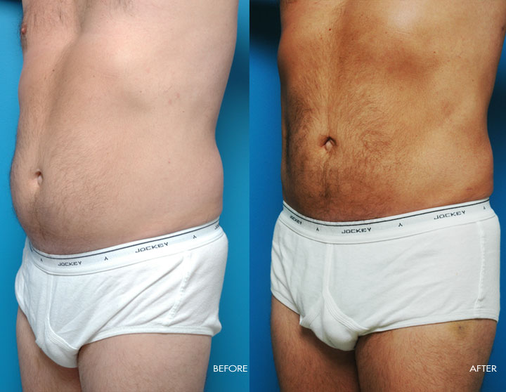Liposuction