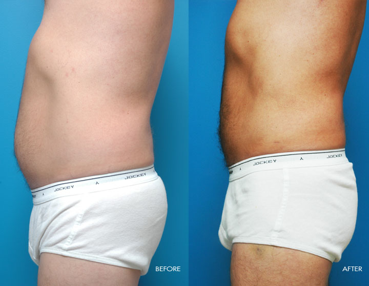 Liposuction