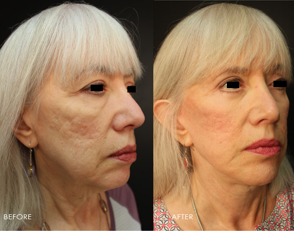 Blepharoplasty