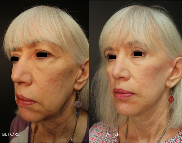 Blepharoplasty