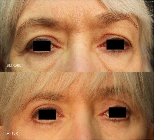 Blepharoplasty