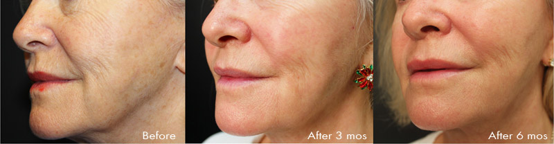 Pre Profound treatment, 3 months post, and 6 months post single Profound Treatment